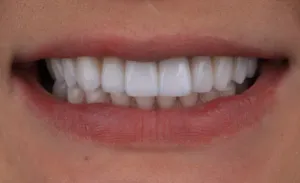 Depois - Linha Média Desviada